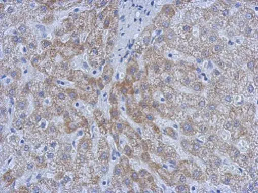 Immunohistochemical analysis of paraffin-embedded Hepatoma,using ATM(GTX77613) antibody at 1:50 dilution.