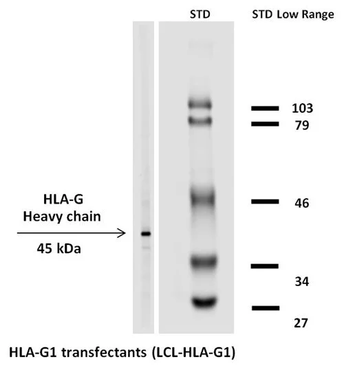 Immunohistochemistry staining with anti-human HLA-G (MEM-G/1). Fig.1A - pulmonary disseases (paraffin-embedded sections) The antibody MEM-G/1 stains infiltrating macrophages in pulmonary diseases.In the top left corner see the detail of macrophage.