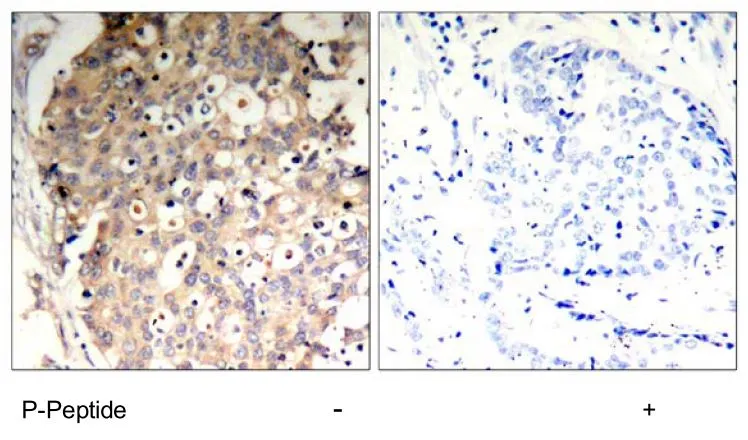 IHC-P analysis of human breast carcinoma tissue using GTX78946 SHP1 (phospho Tyr536) antibody.