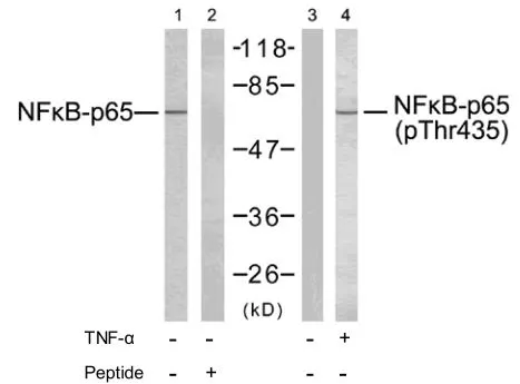 IHC-P analysis of human breast carcinoma tissue using NF ?B p65 (phospho Thr435) antibody in the absence (left) and presence (right) of blocking peptide.