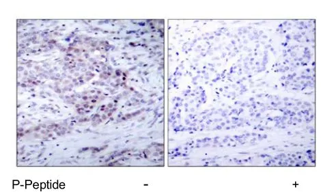 IHC-P analysis of human breast carcinoma tissue using GTX79001 NFkB p100 (phospho Ser869) antibody.