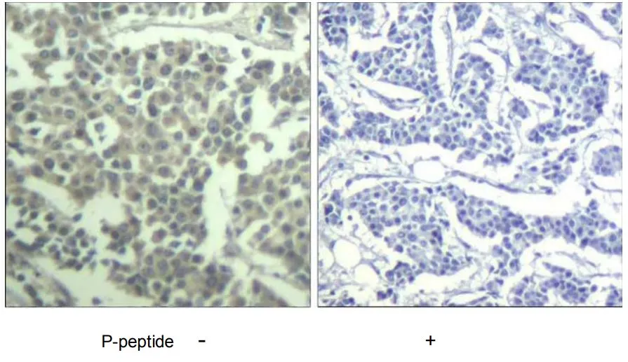 Immunohistochemical analysis of paraffin-embedded human breast carcinoma tissue using c-kit (phospho-Tyr936) Antibody