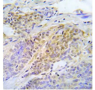 IHC-P analysis of human lung adenocarcinoma tissue using GTX79109 Chk2 (phospho Thr387) antibody.