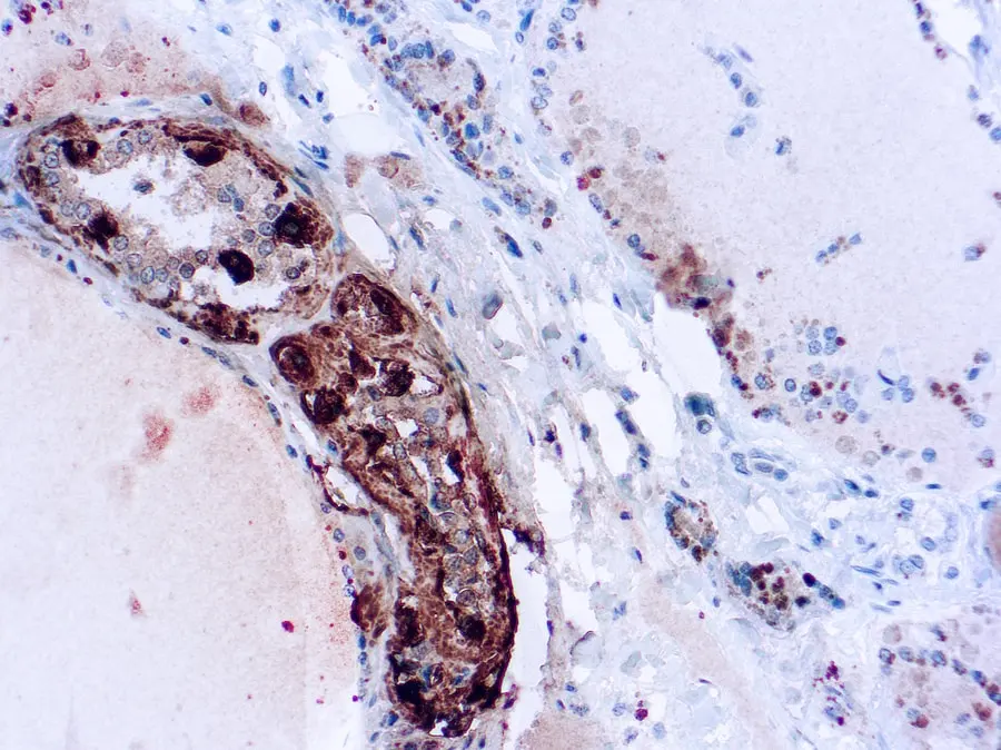 Human Thyroid Medullary Carcinoma stained with anti-Calcitonin antibody