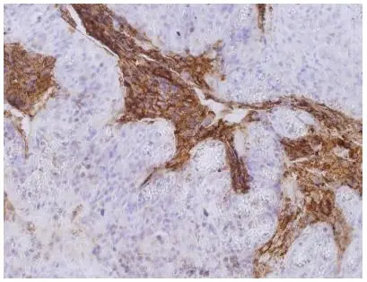 IHC-P analysis of colorectal carcinoma tissue using GTX80201 CD66e antibody [CB30]. Diultion : 10microg/ml
