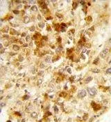 IHC-P analysis of human hepatocarcinoma using GTX80512 PXMP3 antibody, Internal.