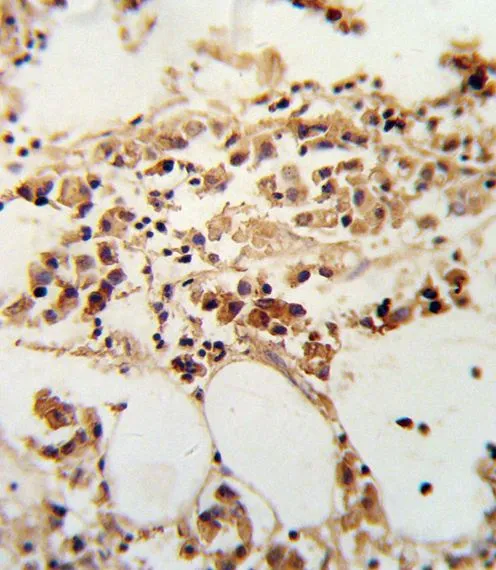 IHC-P analysis of human breast carcinoma using GTX80547 TIMP3 antibody, Internal.