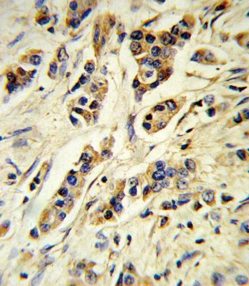 IHC-P analysis of human breast carcinoma using GTX80555 IL10 antibody, Internal.