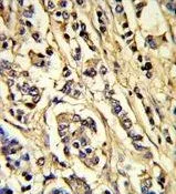 IHC-P analysis of human breast carcinoma using GTX80591 VEGF Receptor 2 antibody.