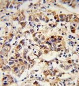 IHC-P analysis of human breast carcinoma using GTX80592 SPRR1B antibody, C-term.