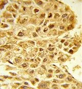 IHC-P analysis of human hepatocarcinoma using GTX80623 E2F5 antibody, N-term.