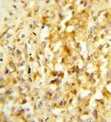 IHC-P analysis of human prostate carcinoma using GTX80628 Nkx3.1 antibody, Internal.