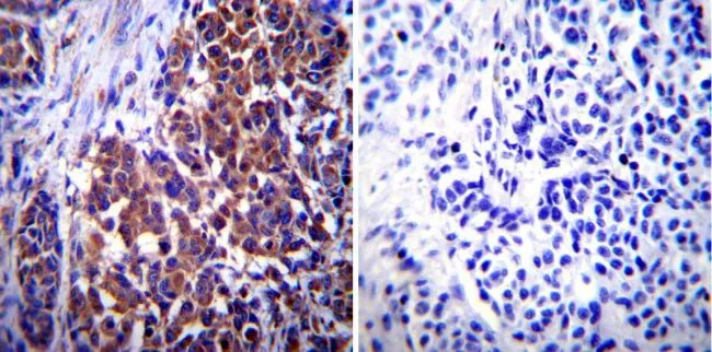 IHC-P analysis of human melanoma tissue using GTX80814 Vimentin antibody [J144]. Left : Primary antibody Right : Negative control without primary antibody Antigen retrieval : heat induced antigen retrieval was performed using 10mM sodium citrate (pH6.0) buffer, microwaved for 8-15 minutes Dilution : 1:1000