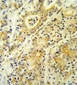 IHC-P analysis of human prostate carcinoma using GTX80967 MGST2 antibody, C-term.