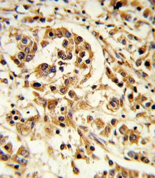 IHC-P analysis of human breast carcinoma using GTX81020 IL12A / IL12 p35 antibody, C-term.