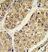 IHC-P analysis of human hepatocarcinoma using GTX81034 CSGALNACT2 antibody, Internal.