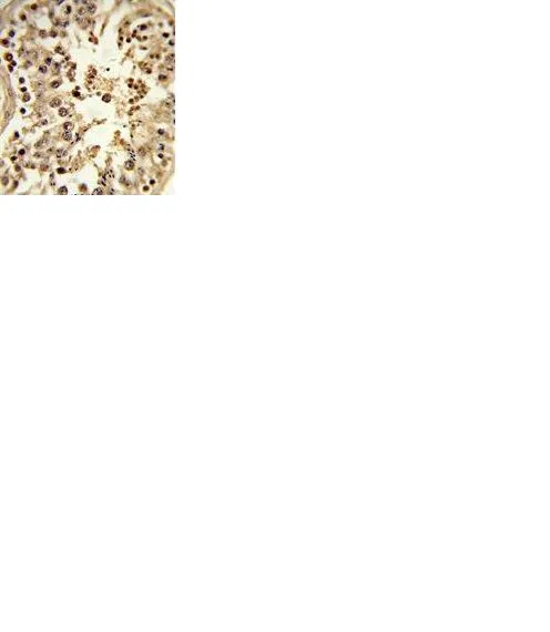 IHC-P analysis of human hepatocarcinoma using GTX81039 DCT antibody, N-term.