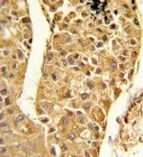 IHC-P analysis of human hepatocarcinoma using GTX81067 CYP2C18 antibody, C-term.