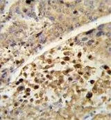 IHC-P analysis of human hepatocarcinoma using GTX81102 PXR antibody, Internal.