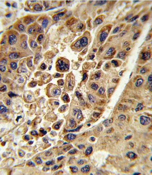 IHC-P analysis of human hepatocarcinoma using GTX81111 KMO antibody, Internal.