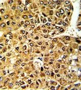 IHC-P analysis of human hepatocarcinoma using GTX81125 MLX antibody, Internal.