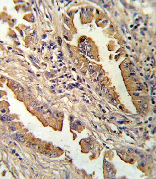 IHC-P analysis of human lung carcinoma using GTX81140 CXCL8 / IL8 antibody, C-term.