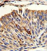 IHC-P analysis of human lung carcinoma using GTX81147 VTI1A antibody, C-term.