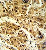 IHC-P analysis of human hepatocarcinoma using GTX81160 Lipin 2 antibody, Internal.