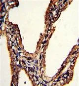 IHC-P analysis of human prostate carcinoma using GTX81175 LMP2 antibody, C-term.