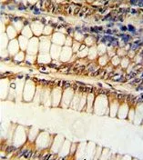 IHC-P analysis of human colon carcinoma using GTX81177 Bim antibody, Internal.