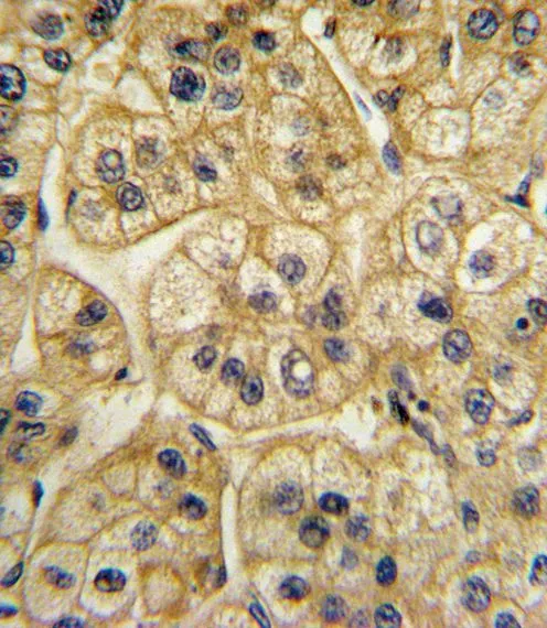 IHC-P analysis of human hepatocarcinoma using GTX81179 AP2A2 antibody, Internal.