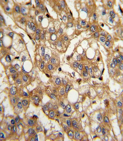 IHC-P analysis of human hepatocarcinoma using GTX81187 IFN beta antibody, N-term.
