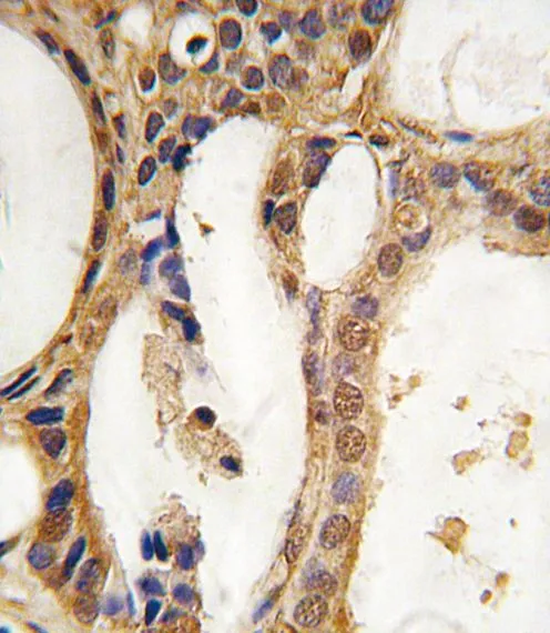 IHC-P analysis of human prostata carcinoma tissue using GTX81239 PIM1 antibody.