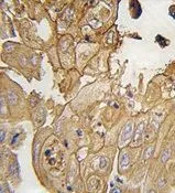 IHC-P analysis of human lung carcinoma using GTX81256 GMFG antibody, N-term. IHC-P analysis of human lung carcinoma using GTX81256 GMFG antibody, N-term.