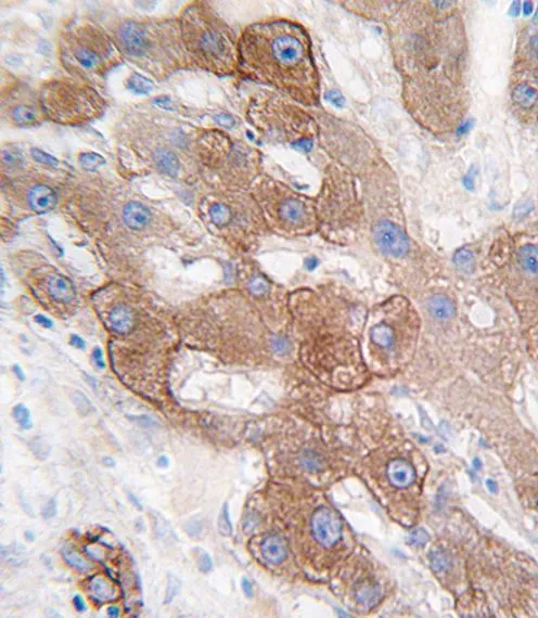 IHC-P analysis of human hepatocarcinoma using GTX81287 Cytochrome P450 3A5 antibody, C-term. IHC-P analysis of human hepatocarcinoma using GTX81287 Cytochrome P450 3A5 antibody, C-term.