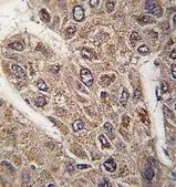 IHC-P analysis of human hepatocarcinoma using GTX81309 BICD2 antibody, C-term. IHC-P analysis of human hepatocarcinoma using GTX81309 BICD2 antibody, C-term.