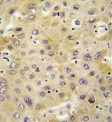 IHC-P analysis of human hepatocarcinoma using GTX81396 NAP2 antibody, C-term. IHC-P analysis of human hepatocarcinoma using GTX81396 NAP2 antibody, C-term.