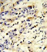 IHC-P analysis of human breast carcinoma using GTX81430 IGHM antibody, N-term. IHC-P analysis of human breast carcinoma using GTX81430 IGHM antibody, N-term.