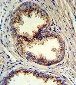IHC-P analysis of human prostate carcinoma using GTX81443 GOLPH3 antibody, N-term. IHC-P analysis of human prostate carcinoma using GTX81443 GOLPH3 antibody, N-term.