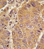 IHC-P analysis of human hepatocarcinoma using GTX81467 Apolipoprotein A1 antibody, N-term. IHC-P analysis of human hepatocarcinoma using GTX81467 Apolipoprotein A1 antibody, N-term.