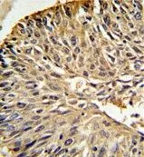 IHC-P analysis of human lung carcinoma using GTX81492 DHFR antibody, C-term. IHC-P analysis of human lung carcinoma using GTX81492 DHFR antibody, C-term.