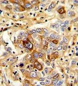 IHC-P analysis of human hepatocarcinoma using GTX81526 CD163 antibody, N-term. IHC-P analysis of human hepatocarcinoma using GTX81526 CD163 antibody, N-term.