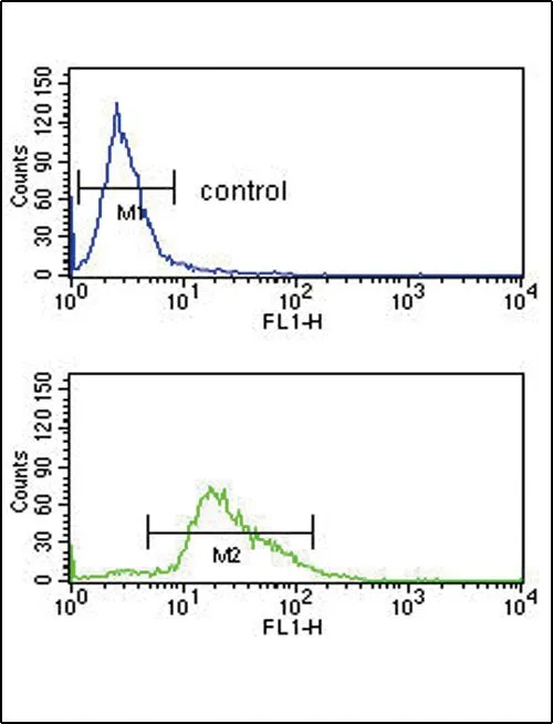 IHC-P analysis of human hepatocarcinoma using GTX81534 PLG antibody,C-term.