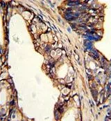IHC-P analysis of human prostate carcinoma using GTX81652 TGM4 antibody, Internal. IHC-P analysis of human prostate carcinoma using GTX81652 TGM4 antibody, Internal.