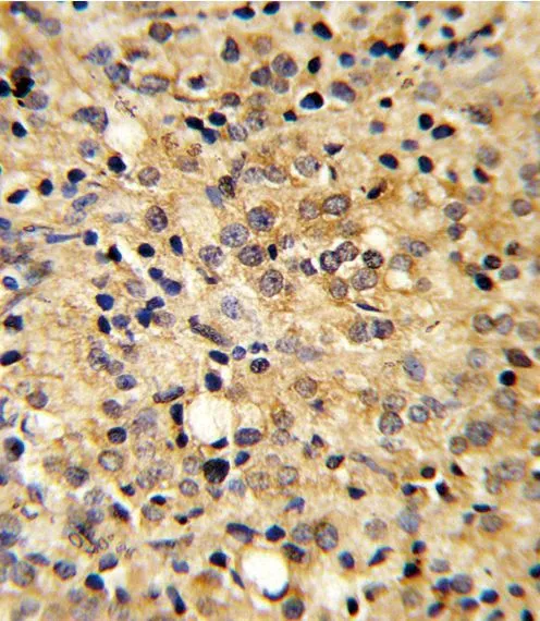 IHC-P analysis of human prostate carcinoma using GTX81660 COMP antibody, Internal. IHC-P analysis of human prostate carcinoma using GTX81660 COMP antibody, Internal.