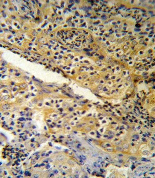 IHC-P analysis of human tonsil using GTX81680 SPINK5 antibody, N-term. IHC-P analysis of human tonsil using GTX81680 SPINK5 antibody, N-term.