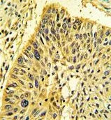 IHC-P analysis of human lung carcinoma using GTX81714 Calponin-1 antibody, N-term. IHC-P analysis of human lung carcinoma using GTX81714 Calponin-1 antibody, N-term.