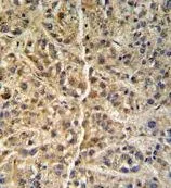 IHC-P analysis of human hepatocarcinoma using GTX81833 GNS antibody, Internal. IHC-P analysis of human hepatocarcinoma using GTX81833 GNS antibody, Internal.