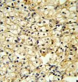 IHC-P analysis of human kidney carcinoma using GTX81853 CD40L / CD154 antibody, C-term. IHC-P analysis of human kidney carcinoma using GTX81853 CD40L / CD154 antibody, C-term.