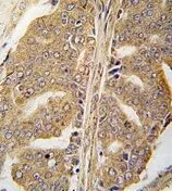 IHC-P analysis of human prostata carcinoma using GTX81889 Paxillin antibody. IHC-P analysis of human prostata carcinoma using GTX81889 Paxillin antibody.